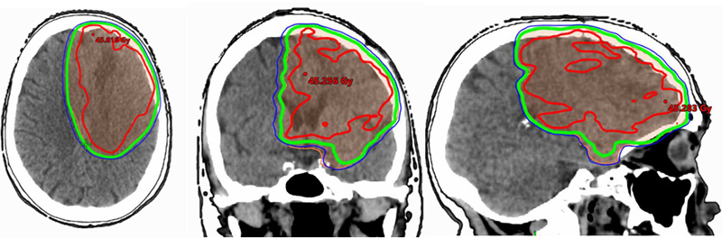 Radiothérapie conformationnelle cerveau
