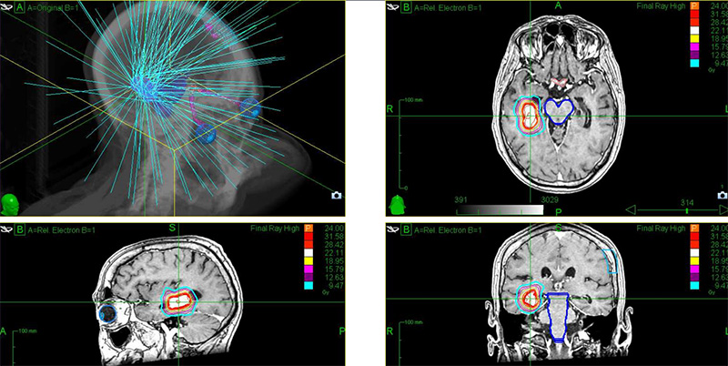 radiotheapie-stereotaxique-cerveau radiotheapie stereotaxique cerveau