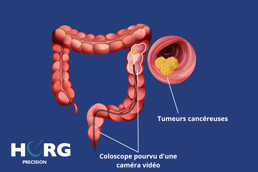 coloscopie cancer colon