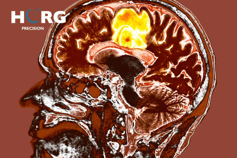 cancer du cerveau Glioblastome cancer du cerveau Glioblastome