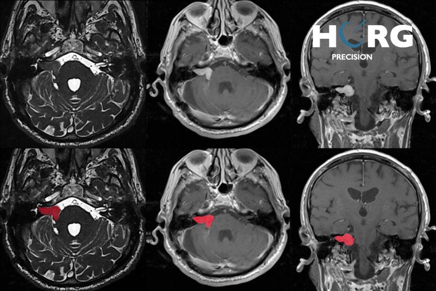 schwannome vestibulaire tumeur intracranienne