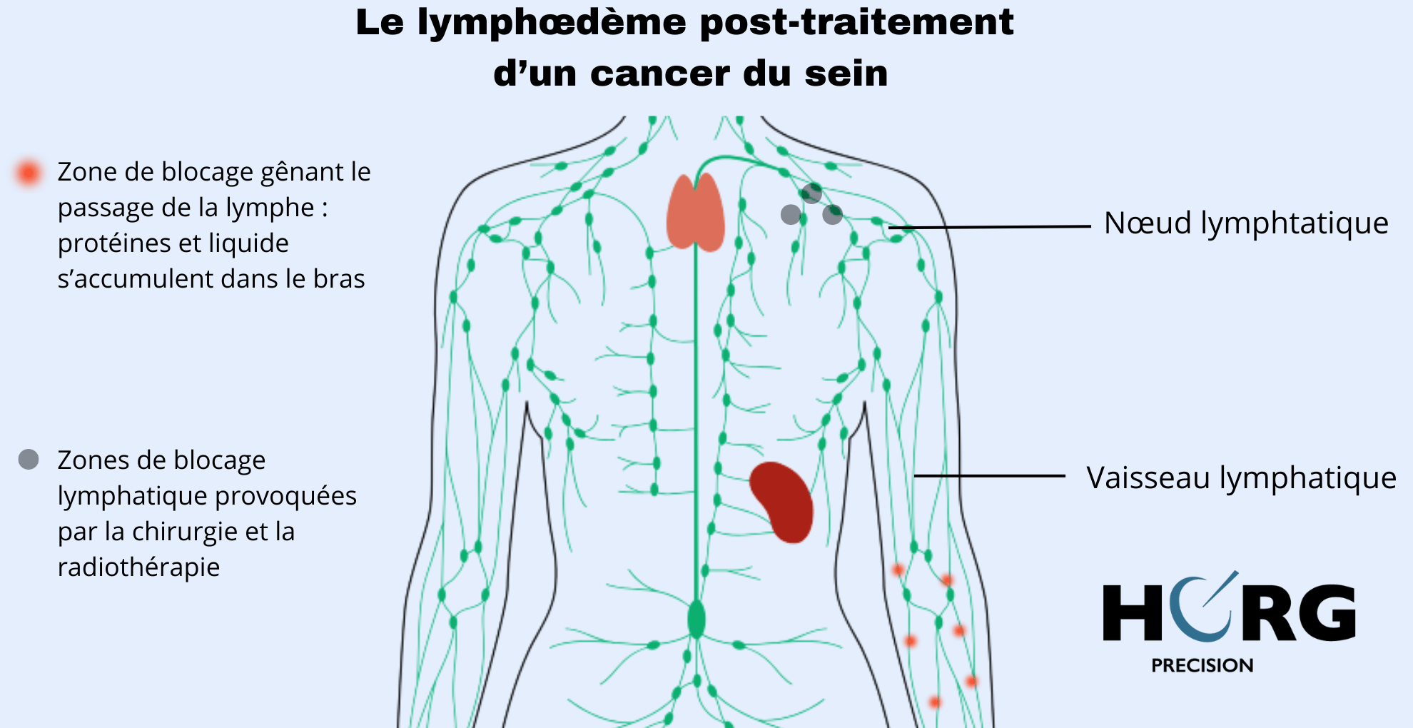 Le lymphoedeme infographie