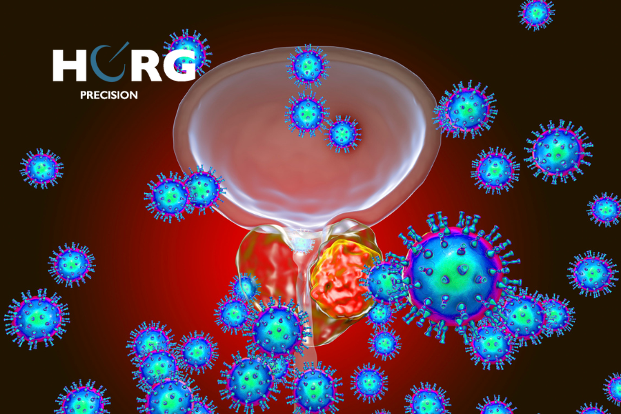 irradier tumeur cancéreuse prostate irradier tumeur cancéreuse prostate