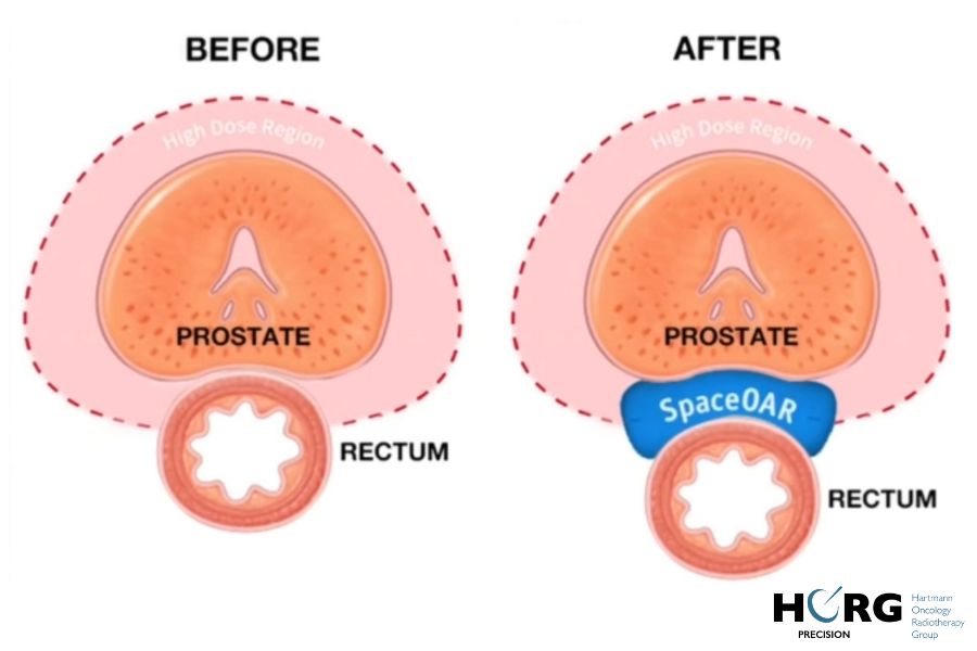 Impact du gel Space OAR