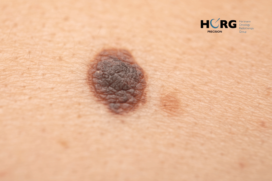 diagnostic m&eacute;lanome