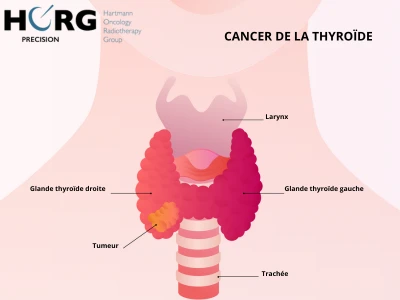 Info cancer thyroide Info cancer thyroide